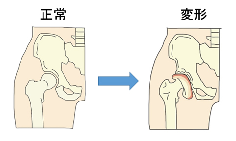 肩変形