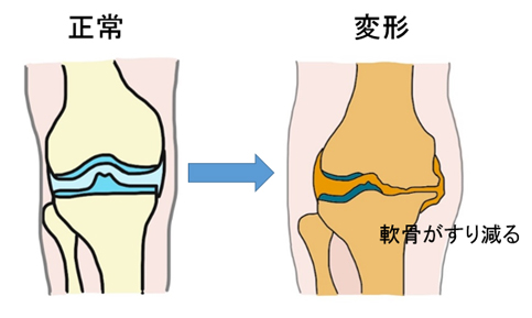 膝変形